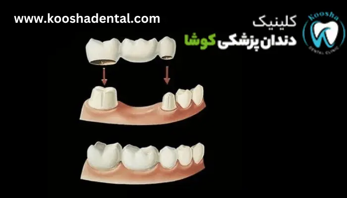 بریج- دندان