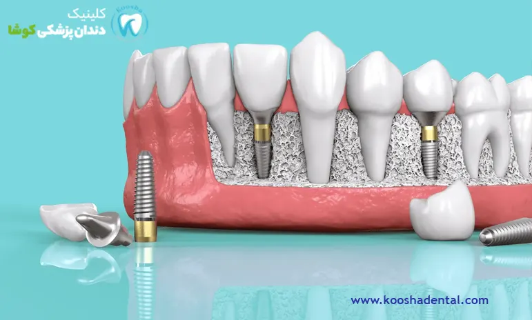 انواع ایمپلنت دندان بر اساس برند