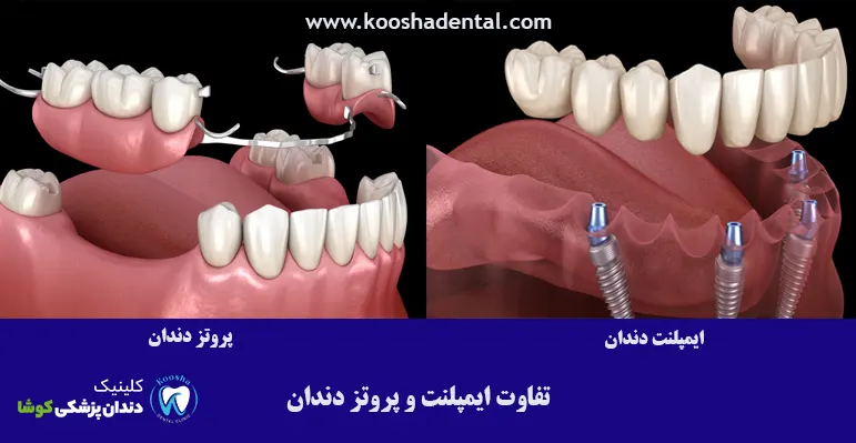 تفاوت-ایمپلنت-پروتز-دندان