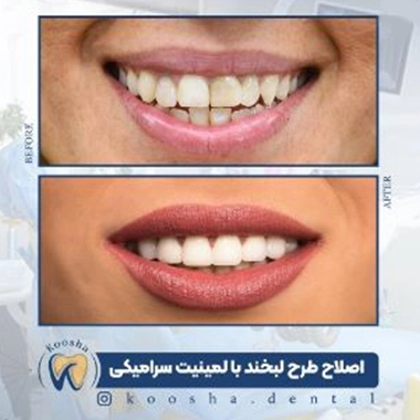 نمونه کار لمینت سرامیکی دندان