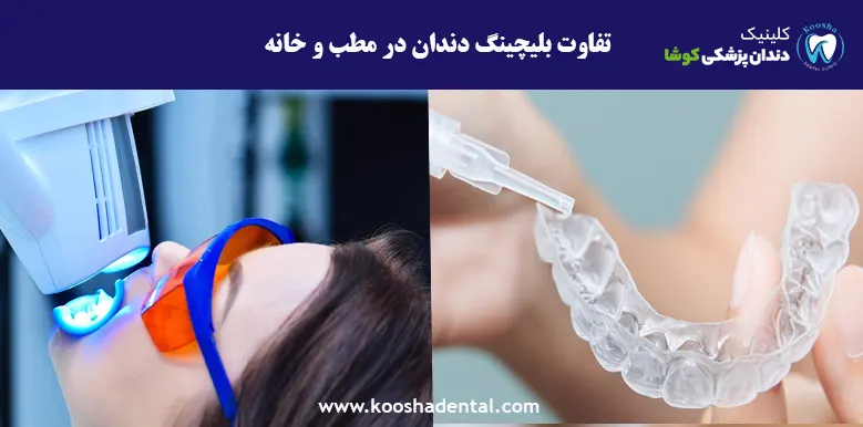 تفاوت بلیچینگ دندان در مطب و خانه