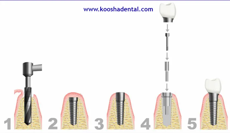 مراحل ایمپلنت دندان آسیاب