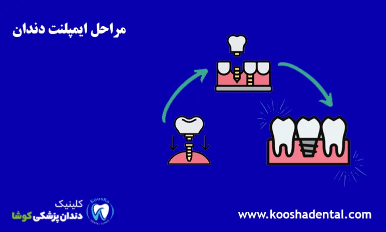 مراحل ایمپلنت دندان